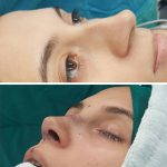 Nose Surgery To Remove Bump Pictures (5)