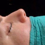 Nostril Cosmetic Surgery (2)