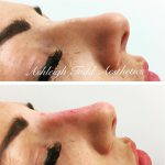 Nostril Cosmetic Surgery (7)