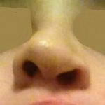 Nostril Cosmetic Surgery (8)