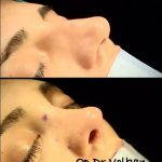 Nostril Cosmetic Surgery (9)