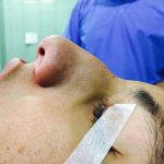 Nostril Flare Surgery (4)