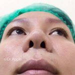 Nostril Reduction Surgery Before And After (6)