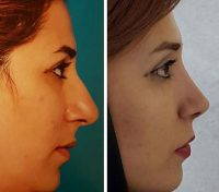 People With Hooked Nose Have A Very Big Nose A Small Jaw Line