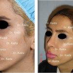 Persian Culture Is Very Accepting Of Rhinoplasty