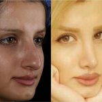 Persian Middle Eastern Rhinoplasty Before And After