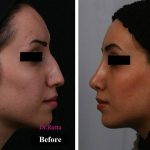 Persian Nose Job Before And After Pictures (2)