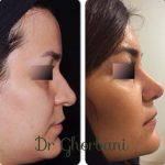 Persian Nose Job Before And After Pictures (4)