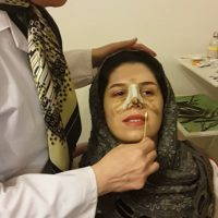 Persian Nose Job To Make The Nasal Tip Look Smaller