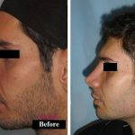 Persian Nose Jobs Before And After Photos (1)