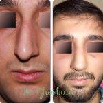 Persian Nose Jobs Before And After Photos (3)