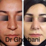 Persian Nose Jobs Before And After Photos (5)