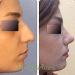 Persian Nose Jobs Before And After Photos (6)