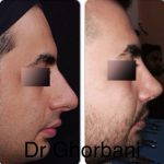 Persian Nose Jobs Before And After Photos (8)