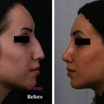 Persian Nose Surgery Photos (1)