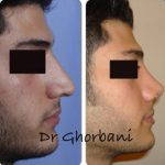 Persian Nose Surgery Photos (3)