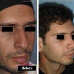 Persian Nose Surgery Photos (4)