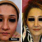 Persian Nose Surgery Photos (5)