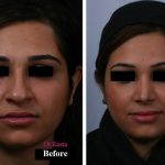 Persian Nose Surgery Photos (8)
