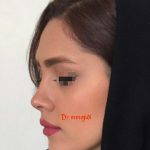 Persian Plastic Surgery For Nose (1)