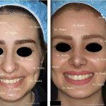 Persian Rhinoplasty Is Also One Of The Most Challenging Nose Surgeries