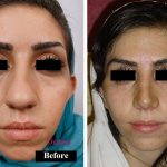 Persian Rhinoplasty Surgical Technique