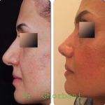Photos Of Iran Nose Surgery (2)