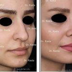 Photos Of Iran Nose Surgery (3)