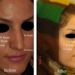 Photos Of Iran Nose Surgery (4)