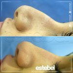 Photos Of Male Rhinoplasty Surgery (3)