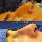 Photos Of Male Rhinoplasty Surgery (4)