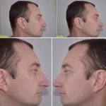 Photos Of Male Rhinoplasty Surgery (5)