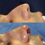 Photos Of Male Rhinoplasty Surgery (6)