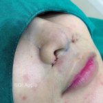 Photos Of Male Rhinoplasty Surgery (8)