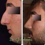 Photos Of Persian Nose Job Before And After (1)