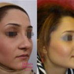 Photos Of Persian Nose Job Before And After (2)