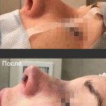 Photos Of Removing A Nose Bump (3)