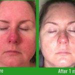 Phymatous Rosacea Before And After