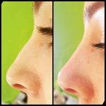 Plastic Surgery For Nose Bump (3)