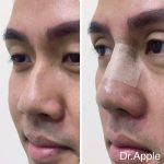 Plastic Surgery For Nose Bump (4)