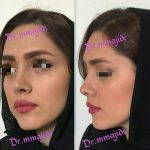 Plastic Surgery For Persian Nose (1)