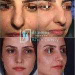 Plastic Surgery For Persian Nose (3)