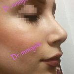 Plastic Surgery For Persian Nose (4)