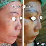 Radiesse Asian Nose Bridge Before And After