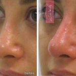 Radiesse For Concealing Nasal Humps Or Bumps