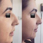 Radiesse For Dips, Divots And Depressions On The Outside Of The Nose