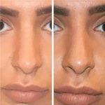 Radiesse For Male Nose Reshaping