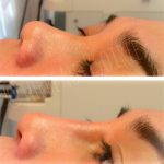 Radiesse For Nose Before And After (1)