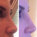 Radiesse For Nose Before And After (2)