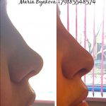 Radiesse For Nose Before And After (4)